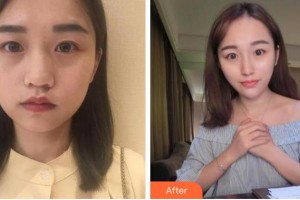 阜陽東方美萊塢醫(yī)療美容醫(yī)院劉小俠整形價格表附抗衰案例展示