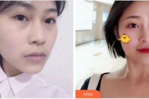 阜陽七院愛爾眼科醫(yī)院尚力強(qiáng)整形價格表附面部抗衰案例展示