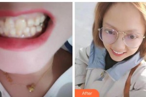 阜陽愛齒口腔門診部陳立志整形價格表附全瓷牙案例展示