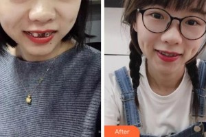 阜陽愛齒口腔門診部李云安整形價格表附金屬托槽矯正案例展示