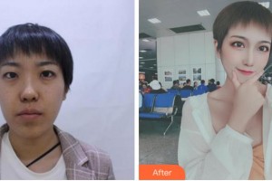 阜陽(yáng)七院愛(ài)爾眼科醫(yī)院孫翠玲整形價(jià)格表附眼部綜合案例展示