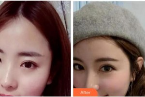 阜陽(yáng)愛(ài)齒口腔門(mén)診部馬厚明整形價(jià)格表附眼部修復(fù)案例展示