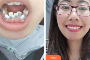 阜陽(yáng)愛(ài)齒口腔門(mén)診部張士彬整形價(jià)格表附金屬托槽矯正案例展示