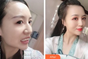 阜陽(yáng)愛(ài)齒口腔門(mén)診部彭博整形價(jià)格表附牙齒隱形矯正案例展示