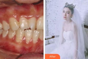 阜陽(yáng)愛(ài)齒口腔門(mén)診部楊靜靜整形價(jià)格表附牙齒隱形矯正案例展示