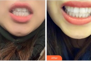 阜陽(yáng)貝德口腔門(mén)診部張永康整形價(jià)格表附隱形托槽矯正案例展示