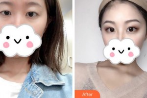 阜陽(yáng)納美星范醫(yī)療美容門(mén)診部高陽(yáng)整形價(jià)格表附切開(kāi)雙眼皮案例展示