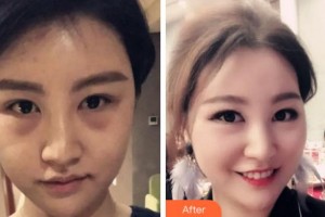 阜陽(yáng)澤明眼科醫(yī)院鹿秀蘭整形價(jià)格表附內(nèi)切祛眼袋案例展示