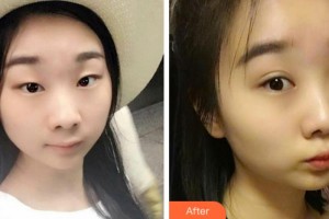 阜陽(yáng)澤明眼科醫(yī)院陳曉艷整形價(jià)格表附切開(kāi)雙眼皮案例展示