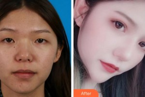 阜陽(yáng)澤明眼科醫(yī)院張桂山整形價(jià)格表附切開(kāi)雙眼皮案例展示