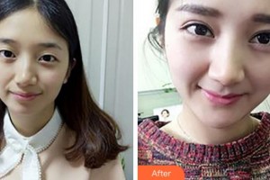 阜陽(yáng)福田眼科醫(yī)院顧永昊整形價(jià)格表附切開(kāi)雙眼皮案例展示