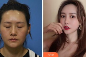 阜陽(yáng)福田眼科醫(yī)院丁健整形價(jià)格表附埋線雙眼皮案例展示