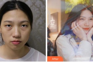 阜陽(yáng)福田眼科醫(yī)院王福田整形價(jià)格表附切開(kāi)雙眼皮案例展示