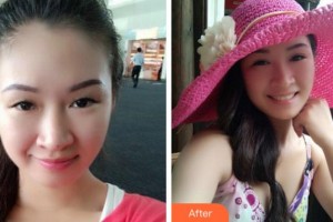 阜陽(yáng)中西醫(yī)結(jié)合眼耳鼻喉科醫(yī)院汝子杰整形價(jià)格表附切開(kāi)雙眼皮案例展示