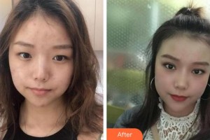 阜陽(yáng)華山醫(yī)院眼科程光輝整形價(jià)格表附開(kāi)內(nèi)眼角案例展示