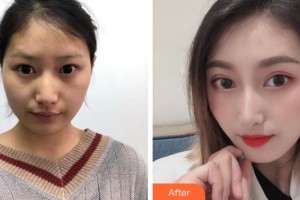 阜陽(yáng)市第七人民醫(yī)院眼科高明煜整形價(jià)格表附開(kāi)內(nèi)眼角案例展示