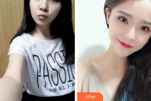 阜陽(yáng)市第五人民醫(yī)院整形美容科袁道毅整形價(jià)格表附眼部綜合案例展示