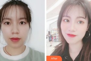 宿州陽(yáng)光醫(yī)療美容醫(yī)院蔣相峰整形價(jià)格表附眼部整形案例展示