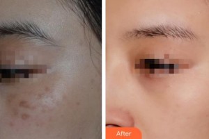 宿州陽(yáng)光醫(yī)療美容醫(yī)院王雙雙整形價(jià)格表附激光祛痣案例展示