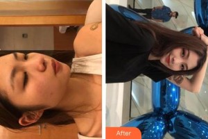 宿州康麗醫(yī)療美容門(mén)診部李夢(mèng)義整形價(jià)格表附光子嫩膚案例展示