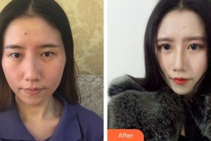 宿州漢密爾頓醫(yī)學美容醫(yī)院方明松整形價格表附鼻修復案例展示