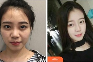 宿州漢密爾頓醫(yī)學美容醫(yī)院樸尚恩整形價格表附隆鼻案例展示