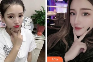 宿州漢密爾頓醫(yī)學美容醫(yī)院鐘貴紅整形價格表附鼻部綜合案例展示