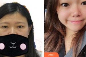 宿州市立醫(yī)院眼科黃超整形價格表附去眼袋案例展示