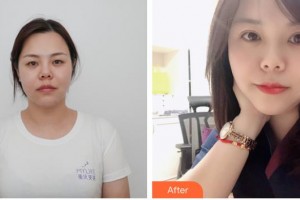 宿州京美醫(yī)療美容醫(yī)院年京京整形價格表附雙眼皮案例展示