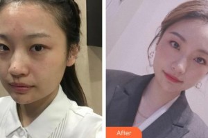 巢湖麗膚中西醫(yī)結(jié)合門診部醫(yī)療美容科馮舸整形價格表附祛斑案例展示