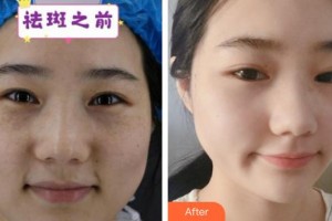 六安市人民醫(yī)院醫(yī)學美容中心邢紅整形價格表附祛斑案例展示