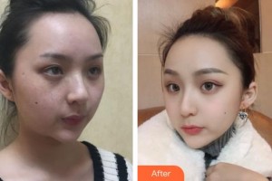 六安市人民醫(yī)院醫(yī)學美容中心余培銀整形價格表附祛斑案例展示