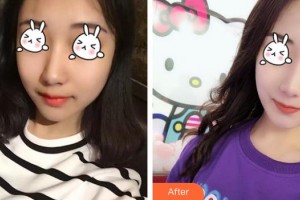 六安伊而美醫(yī)療整形美容醫(yī)院水慶亮整形價格表附光子嫩膚案例展示