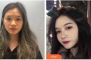 六安市中醫(yī)院眼科嚴靜整形價格表附眼部整形案例展示