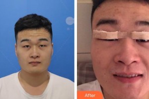 六安瑞視眼科醫(yī)院劉玉整形價格表附眼部整形案例展示