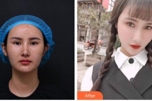 六安瑞視眼科醫(yī)院陳寶海整形價格表附眼部修復案例展示