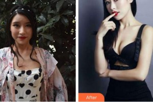 亳州華美整形美容醫(yī)院李劍整形價格表附隆胸案例展示