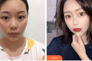 亳州市人民醫(yī)院整形外科薛仰杰整形價格表附眼部手術案例展示