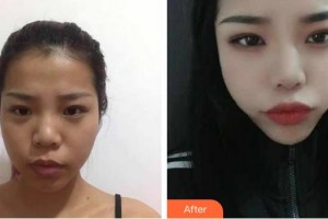 亳州雷賽眼科醫(yī)院楊德勝整形價格表附眼部案例展示