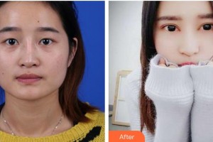 亳州雷賽眼科醫(yī)院周湘紅整形價格表附眼部手術案例展示