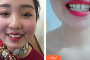 亳州康美口腔醫(yī)院趙威整形價格表附牙齒矯正案例展示