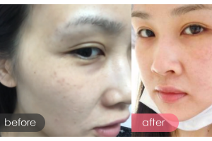 廣州市第十二人民醫(yī)院整形美容科何榮國整形價(jià)格表附皮膚微秒案例展示