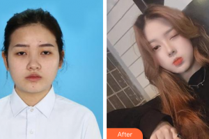 廣州艾美醫(yī)療美容門診部李琳整形價(jià)格表附鼻部綜合案例展示