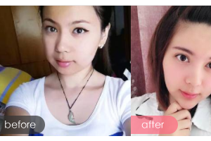 廣州愛來（原阿瑪施）醫(yī)療美容整形醫(yī)院王志農(nóng)整形價(jià)格表附下頜角整形案例展示