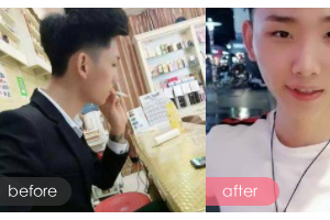 廣州醫(yī)學(xué)院第二附屬醫(yī)院整形美容中心風(fēng)儀萍整形價(jià)格表附陰莖延長案例展示