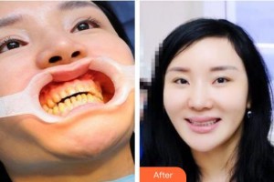 池州伊尚美醫(yī)療美容門診部許黎龍整形價格表附牙齒矯正案例展示