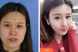 池州伊尚美醫(yī)療美容門診部江啟富整形價(jià)格表附鼻部綜合案例展示