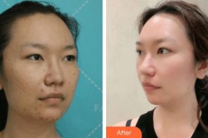 池州愛爾眼科醫(yī)院汪勝利整形價(jià)格表附切開雙眼皮案例展示