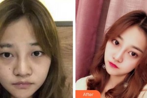 池州愛爾眼科醫(yī)院童曉陸整形價(jià)格表附切開雙眼皮案例展示