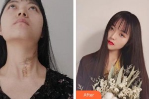 宣城人民醫(yī)院燒傷整形科劉登河整形價(jià)格表附燙傷疤痕修復(fù)案例展示